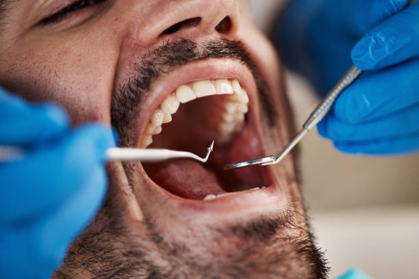 Best Emergency Wisdom Teeth Removal in Grenada, MS